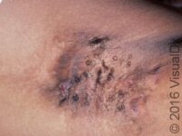 Hidradenitis Suppurativa