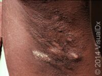 Hidradenitis Suppurativa