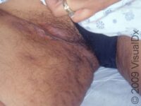 Hidradenitis Suppurativa
