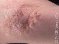 Hidradenitis Suppurativa – Adult