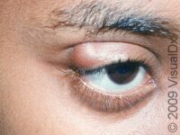 Stye (Hordeolum and Chalazion) – Adult