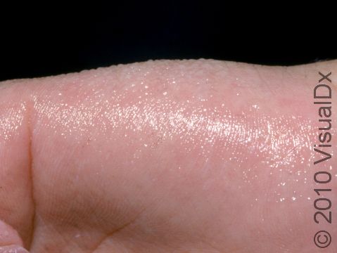 Beads of sweat on the palm of a patient with hyperhidrosis.