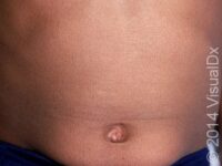 Scaly Skin (Ichthyosis Vulgaris)