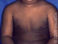 Scaly Skin (Ichthyosis Vulgaris)