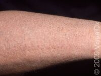 Scaly Skin (Ichthyosis Vulgaris) – Adult