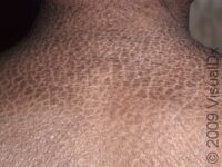 Scaly Skin (Ichthyosis Vulgaris)