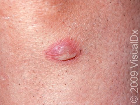 This image displays a pus-filled lesion with crust due to impetigo, a superficial skin infection from either strep or staph bacteria.