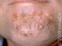 Impetigo – Adult