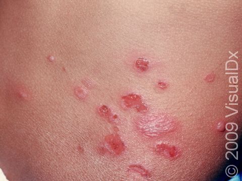 This image displays intact blisters and crusted erosions showing the spectrum of skin lesions typical of impetigo.