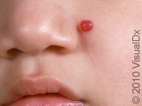 A small early hemangioma on the left cheek.