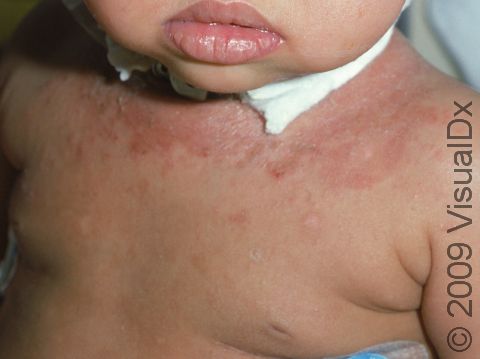 This hospitalized infant with irritant contact dermatitis had chafing and irritation from the bandage around the neck.