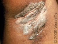 Irritant Contact Dermatitis