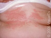 Irritant Contact Dermatitis