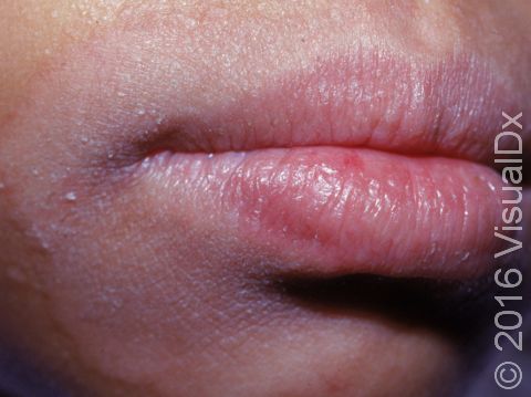 Irritation has caused rough, scaly, and lighter skin areas around the mouth.