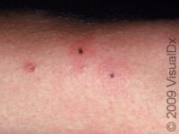 Irritant Contact Dermatitis