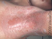 Irritant Contact Dermatitis