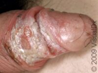 Irritant Contact Dermatitis