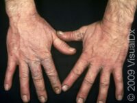 Irritant Contact Dermatitis