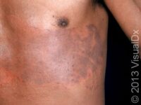 Irritant Contact Dermatitis