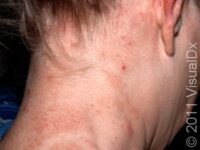 Irritant Contact Dermatitis