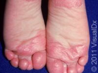 Juvenile Plantar Dermatosis – Child