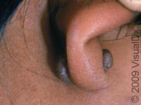 Keloid