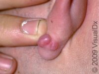 Keloid