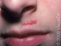 Keloid