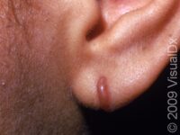 Keloid