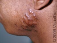 Keloid