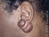 Keloid