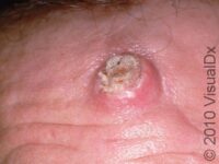 Keratoacanthoma