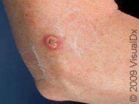 Keratoacanthoma