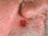 Keratoacanthoma