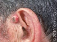 Keratoacanthoma