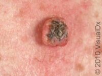 Keratoacanthoma