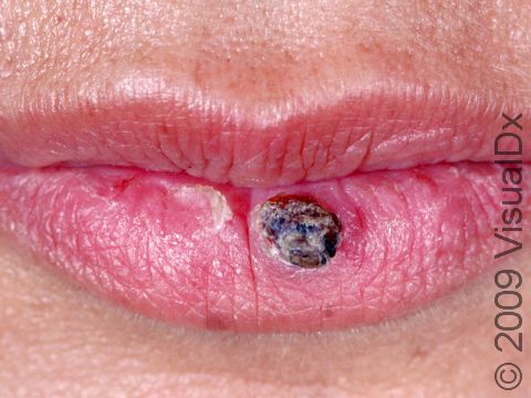 This image displays a keratoacanthoma on the lip.