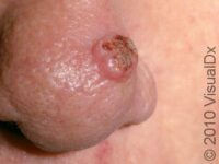 Keratoacanthoma