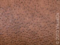 Keratosis Pilaris