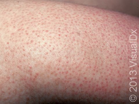 The pronounced appearance of each hair follicle is typical of keratosis pilaris.