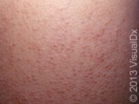 Keratosis Pilaris