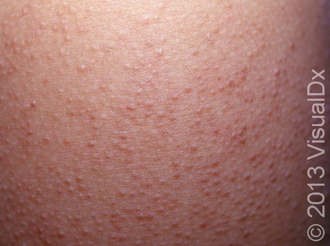 This image displays the pink bumps typical of keratosis pilaris.