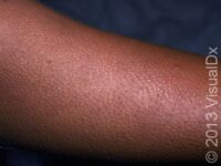 Keratosis Pilaris