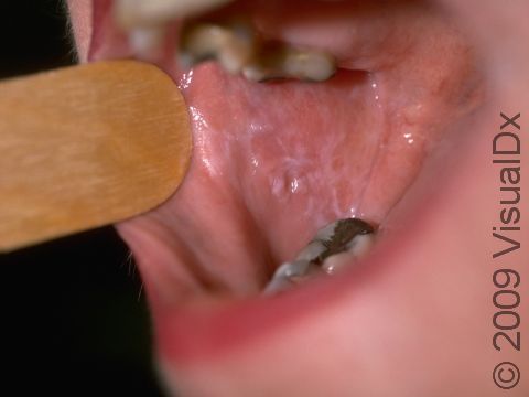 Net-like, white, slightly elevated lesions inside the mouth are typical of oral lichen planus.