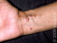 Lichen Planus