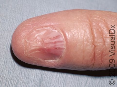 This image displays nails with thin, longitudinal ridges typical of lichen planus.