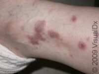 Lichen Planus