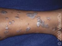 Lichen Planus