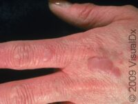 Lichen Simplex Chronicus