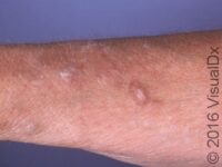 Lichen Simplex Chronicus